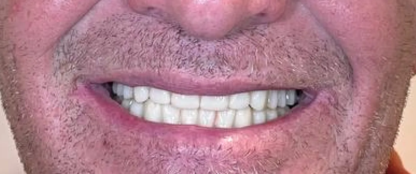 After view of dental case 01 by Dr Desmond Ng