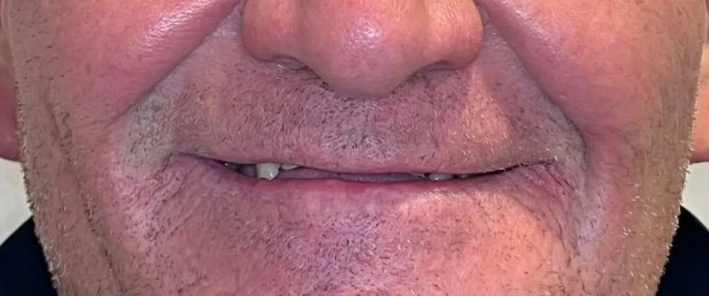 Before view of dental case 01 by Dr Desmond Ng