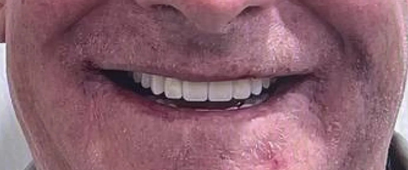 After view of dental case 02 by Dr Desmond Ng