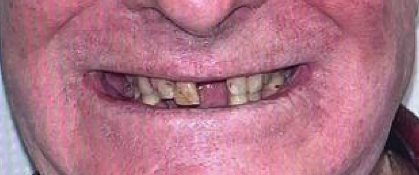 Before view of dental case 02 by Dr Desmond Ng