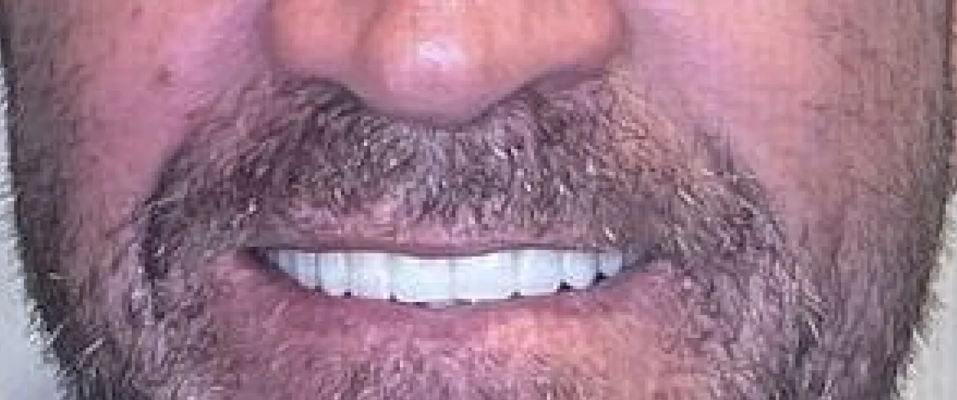 After view of dental case 03 by Dr Desmond Ng