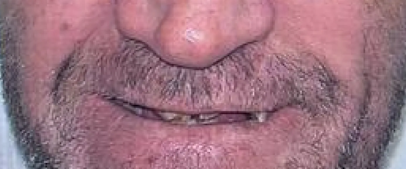 Before view of dental case 03 by Dr Desmond Ng