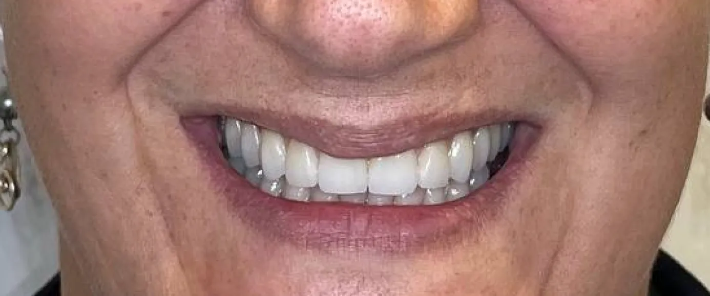After view of dental case 04 by Dr Desmond Ng