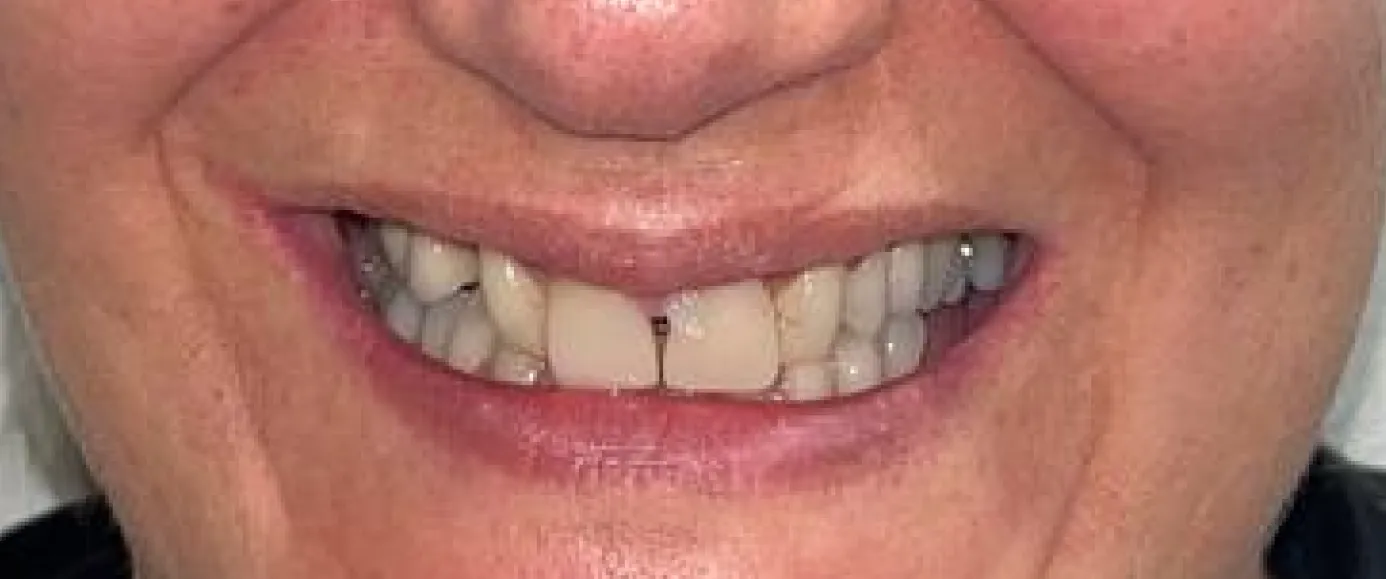 Before view of dental case 04 by Dr Desmond Ng