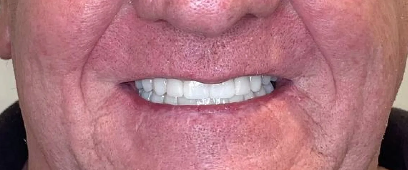 After view of dental case 05 by Dr Desmond Ng