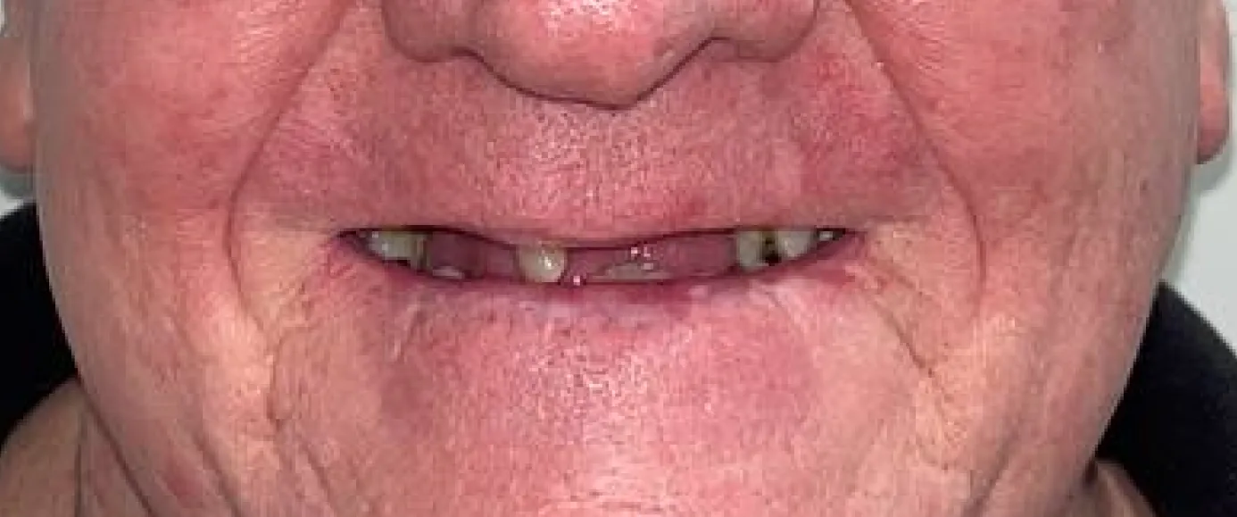 Before view of dental case 05 by Dr Desmond Ng