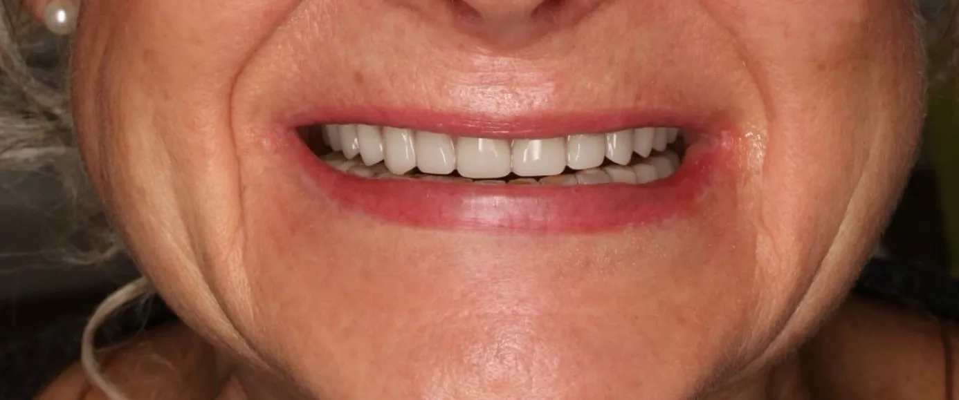 After view of dental case 06 by Dr Desmond Ng