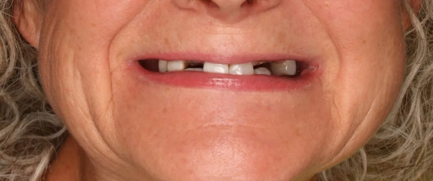 Before view of dental case 06 by Dr Desmond Ng