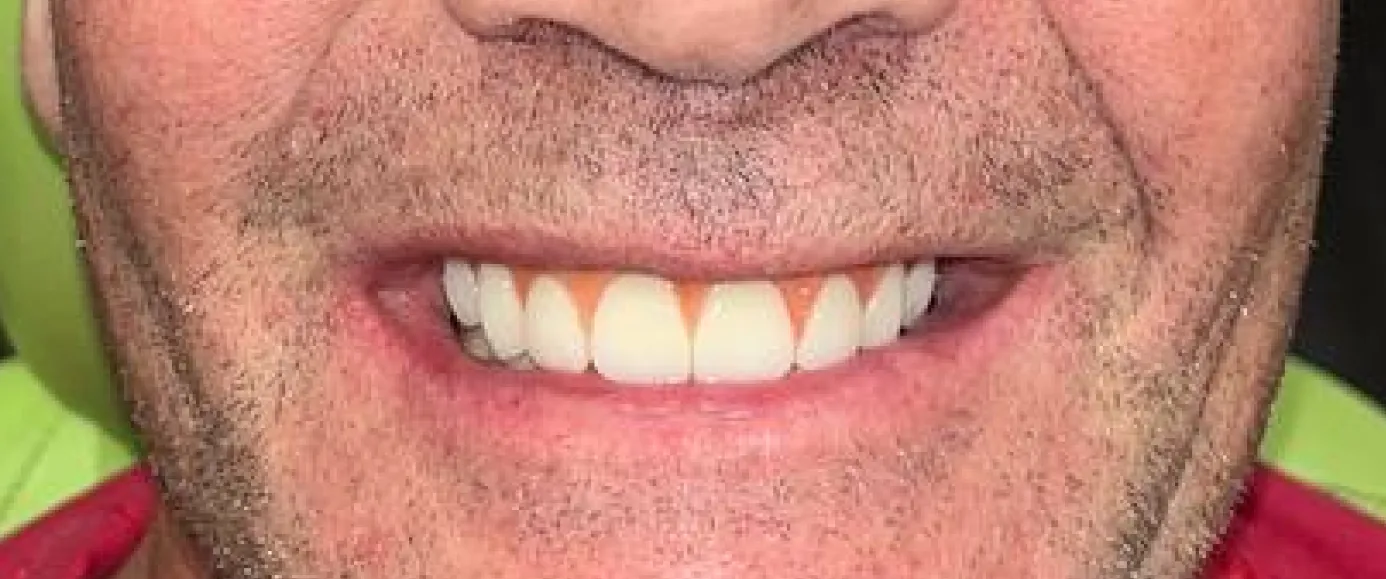 After view of dental case 07 by Dr Desmond Ng