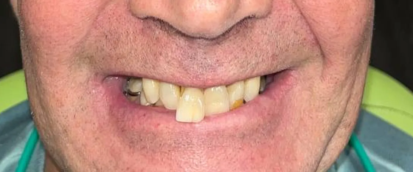 Before view of dental case 07 by Dr Desmond Ng