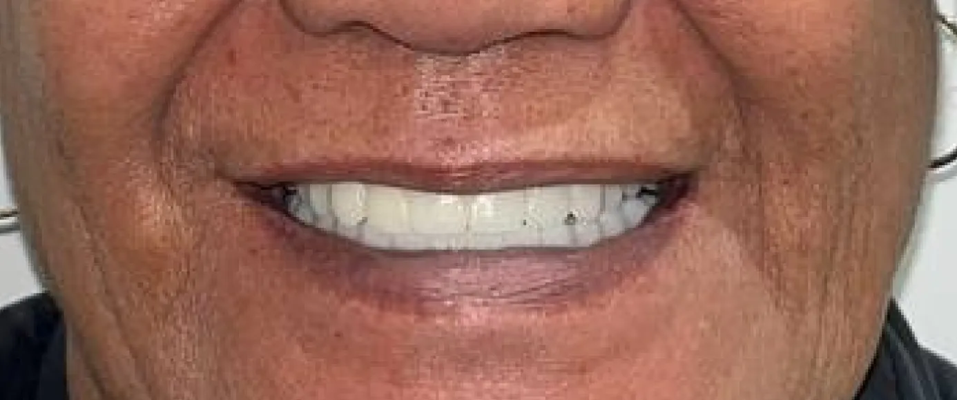 After view of dental case 08 by Dr Desmond Ng