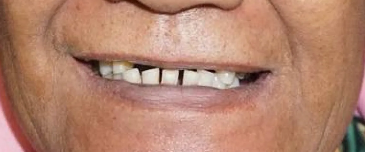 Before view of dental case 08 by Dr Desmond Ng