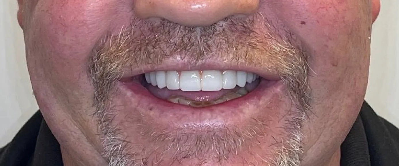After view of dental case 09 by Dr Desmond Ng