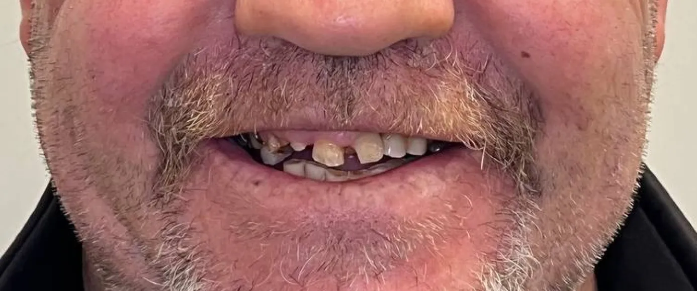 Before view of dental case 09 by Dr Desmond Ng