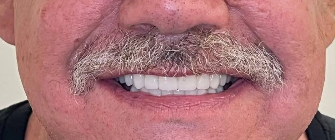 After view of dental case 10 by Dr Desmond Ng