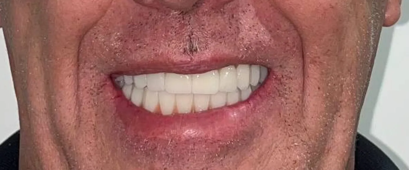 After view of dental case 11 by Dr Desmond Ng