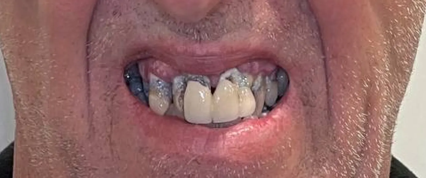 Before view of dental case 11 by Dr Desmond Ng