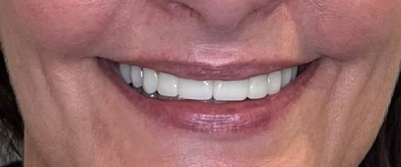 After view of dental case 12 by Dr Desmond Ng