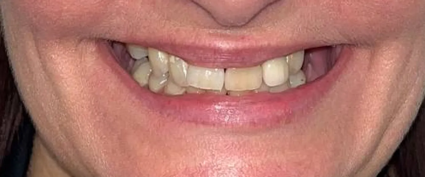 Before view of dental case 12 by Dr Desmond Ng
