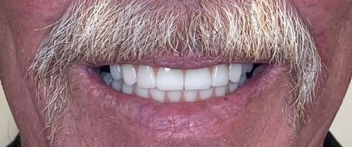 After view of dental case 13 by Dr Desmond Ng