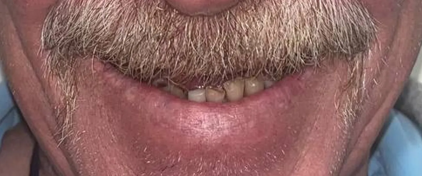 Before view of dental case 13 by Dr Desmond Ng