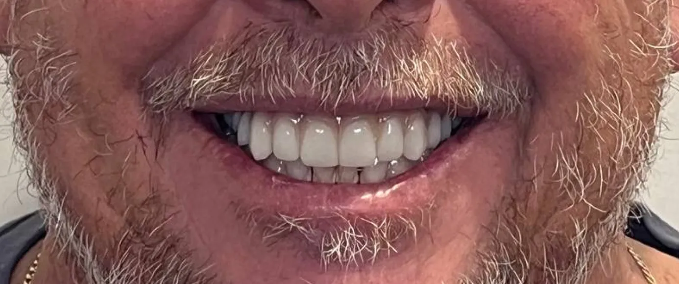 After view of dental case 14 by Dr Desmond Ng