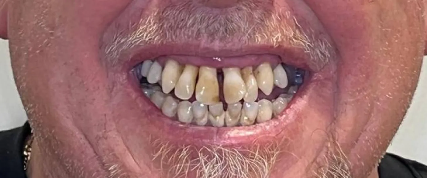 Before view of dental case 14 by Dr Desmond Ng