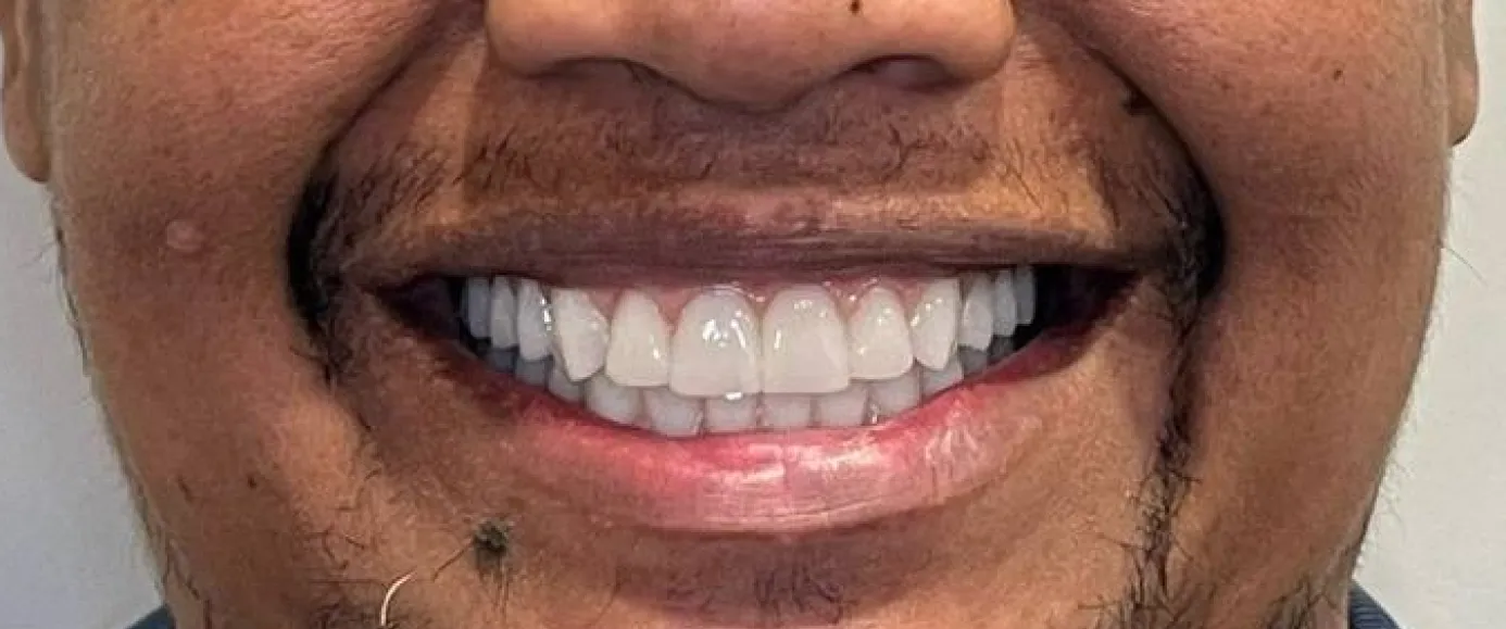 After view of dental case 15 by Dr Desmond Ng