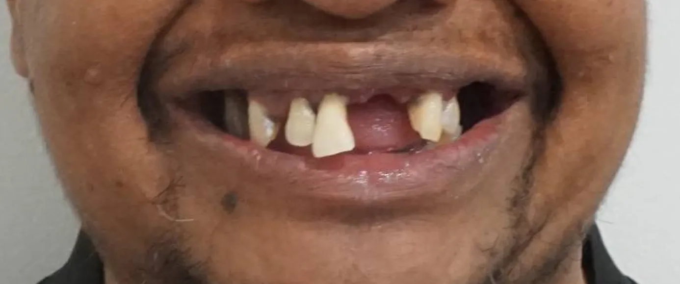Before view of dental case 15 by Dr Desmond Ng