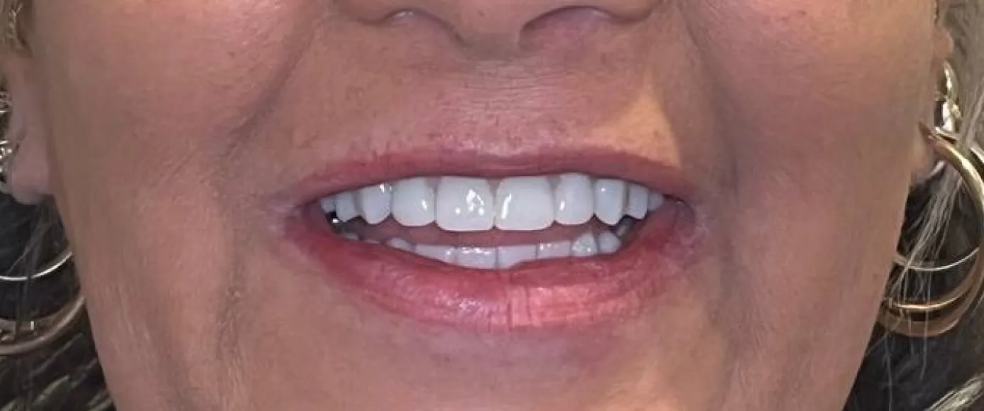 After view of dental case 16 by Dr Desmond Ng