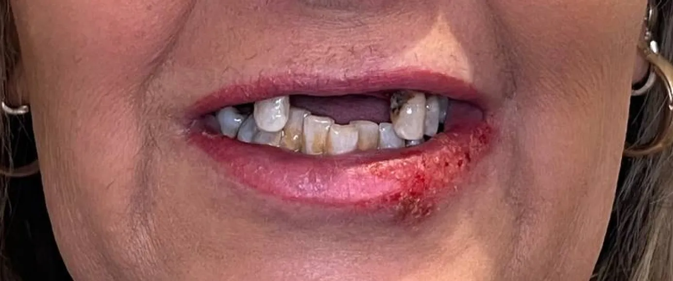 Before view of dental case 16 by Dr Desmond Ng