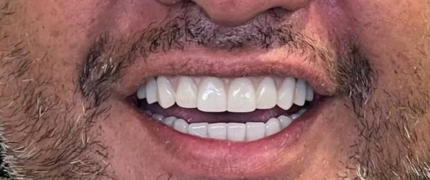 After view of dental case 17 by Dr Desmond Ng