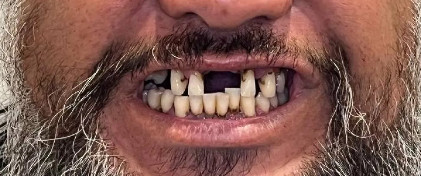 Before view of dental case 17 by Dr Desmond Ng